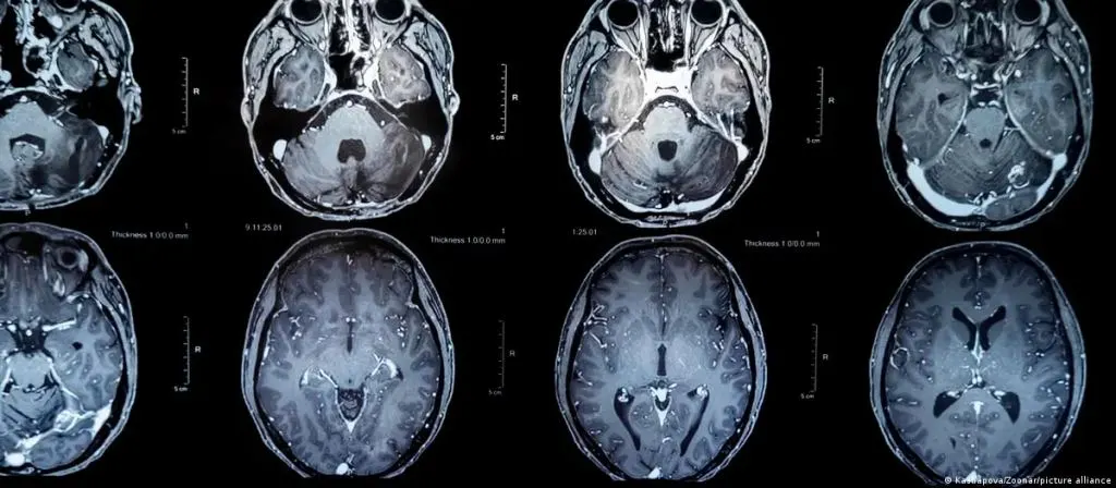 Tumores cerebrales: nueva vacuna ofrece esperanza de vida