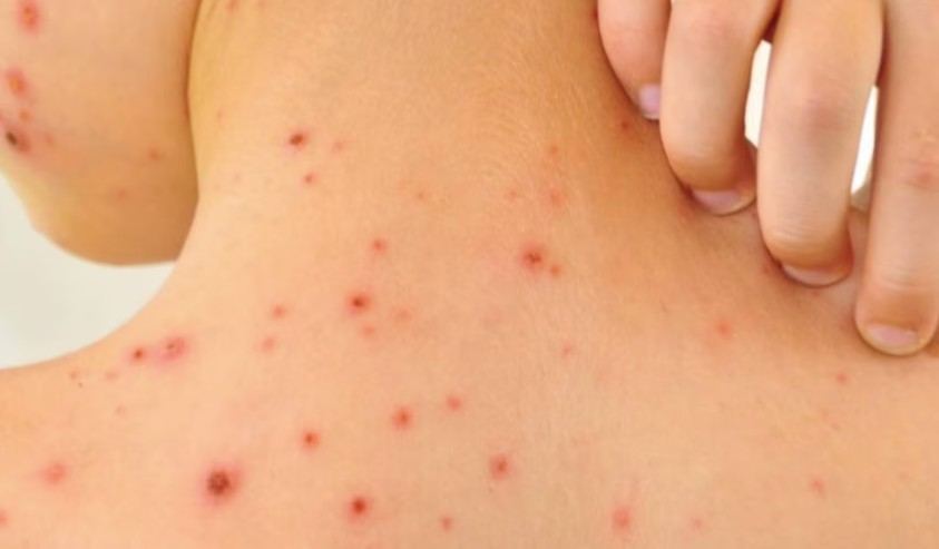 Brasil refuerza vacunación y vigilancia ante avance de sarampión en América
