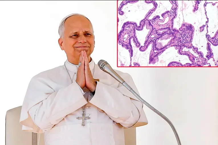 Qué es el adenocarcinoma pulmonar detectado al Papa: síntomas, causas y tratamientos de este tipo de cáncer