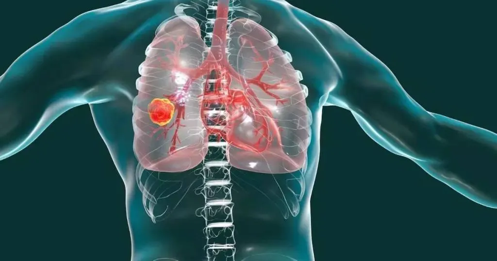 Qué es un adenocarcinoma pulmonar, el tumor maligno que le diagnosticaron a León XIV