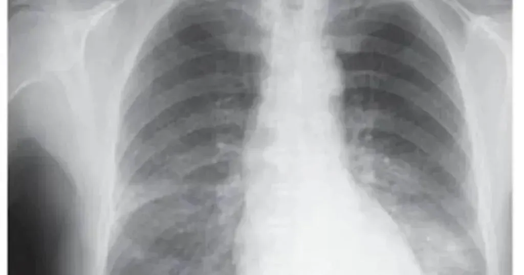 Qué es un adenocarcinoma pulmonar, la enfermedad respiratoria que tiene el papa León XIV