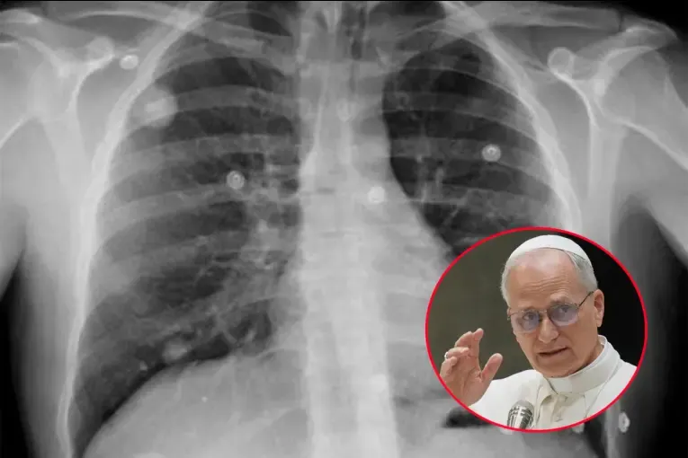 Qué es un nódulo pulmonar, la afección por la que será operado el papa León XIV